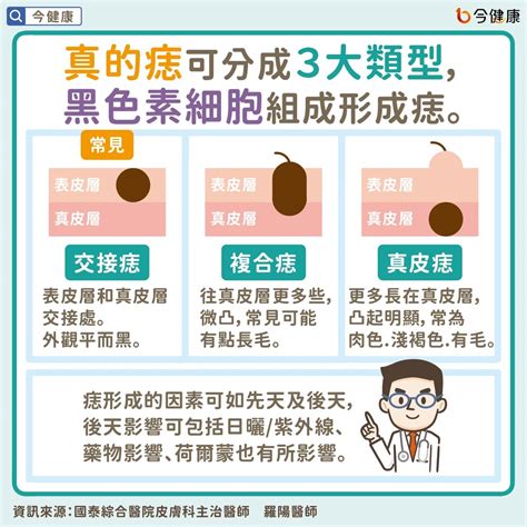 手臂痣長毛代表什麼|是痣？皮膚癌？還是什麼？常見Q&A解惑！醫教揪出「。